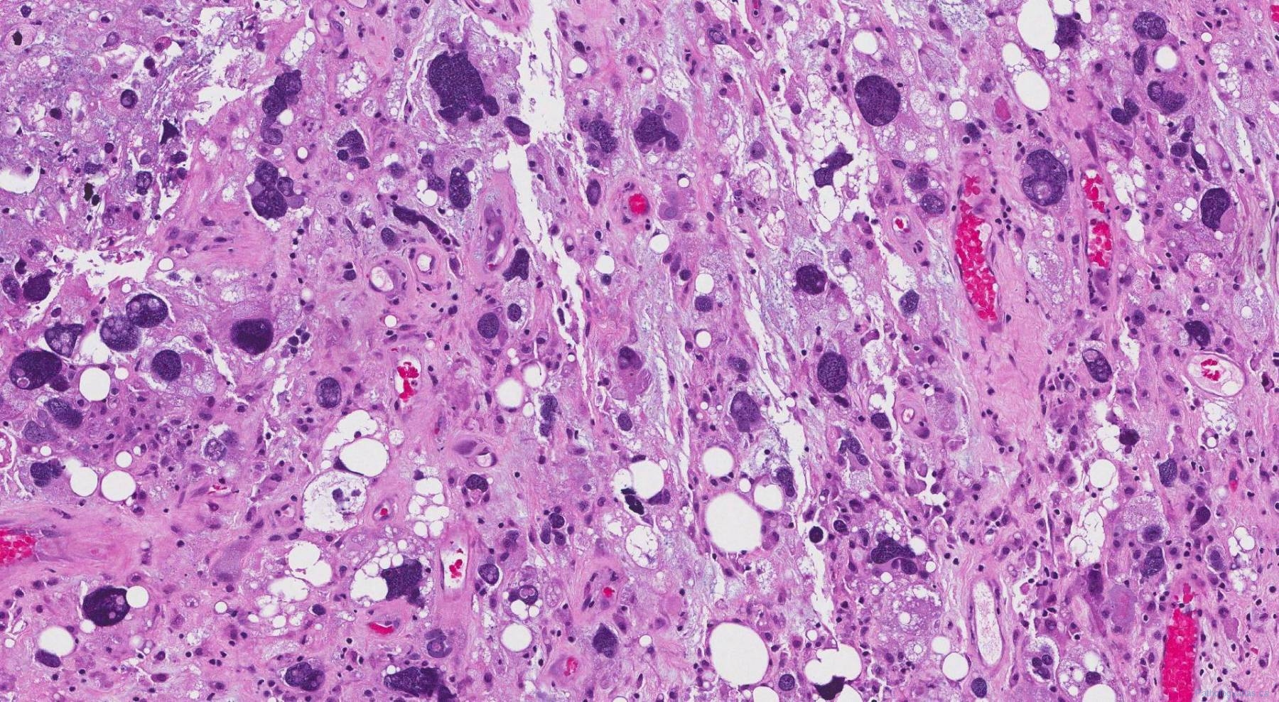 Liposarcoma Pathophysiology Wikidoc