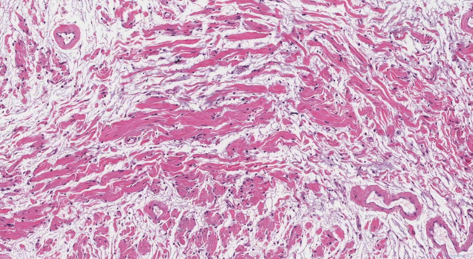 Plexiform Neurofibroma Atlas Of Pathology