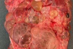 Polycystic kidney disease