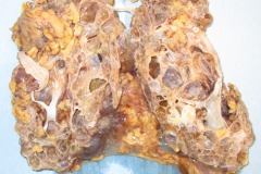 Polycystic kidney disease