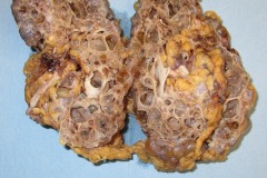 Polycystic kidney disease