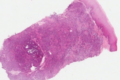 Polymorphous adenocarcinoma