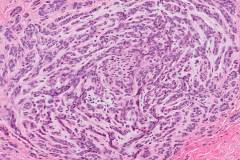 Polymorphous adenocarcinoma