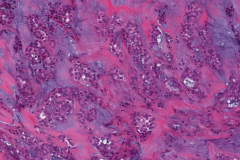 Polymorphous adenocarcinoma, cribriform subtype