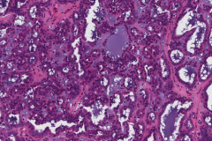 Polymorphous adenocarcinoma, cribriform subtype