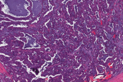 Polymorphous adenocarcinoma, cribriform subtype