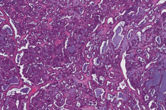 Polymorphous adenocarcinoma, cribriform subtype