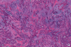 Polymorphous adenocarcinoma, cribriform subtype