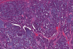 Polymorphous adenocarcinoma, cribriform subtype