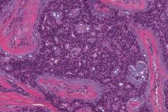 Polymorphous adenocarcinoma, cribriform subtype