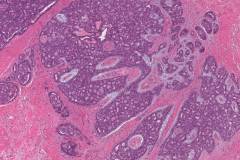 Polymorphous adenocarcinoma, cribriform subtype