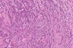 Polymorphous adenocarcinoma