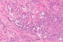 Polymorphous adenocarcinoma