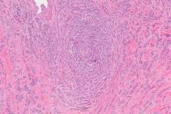 Polymorphous adenocarcinoma