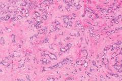 Polymorphous adenocarcinoma