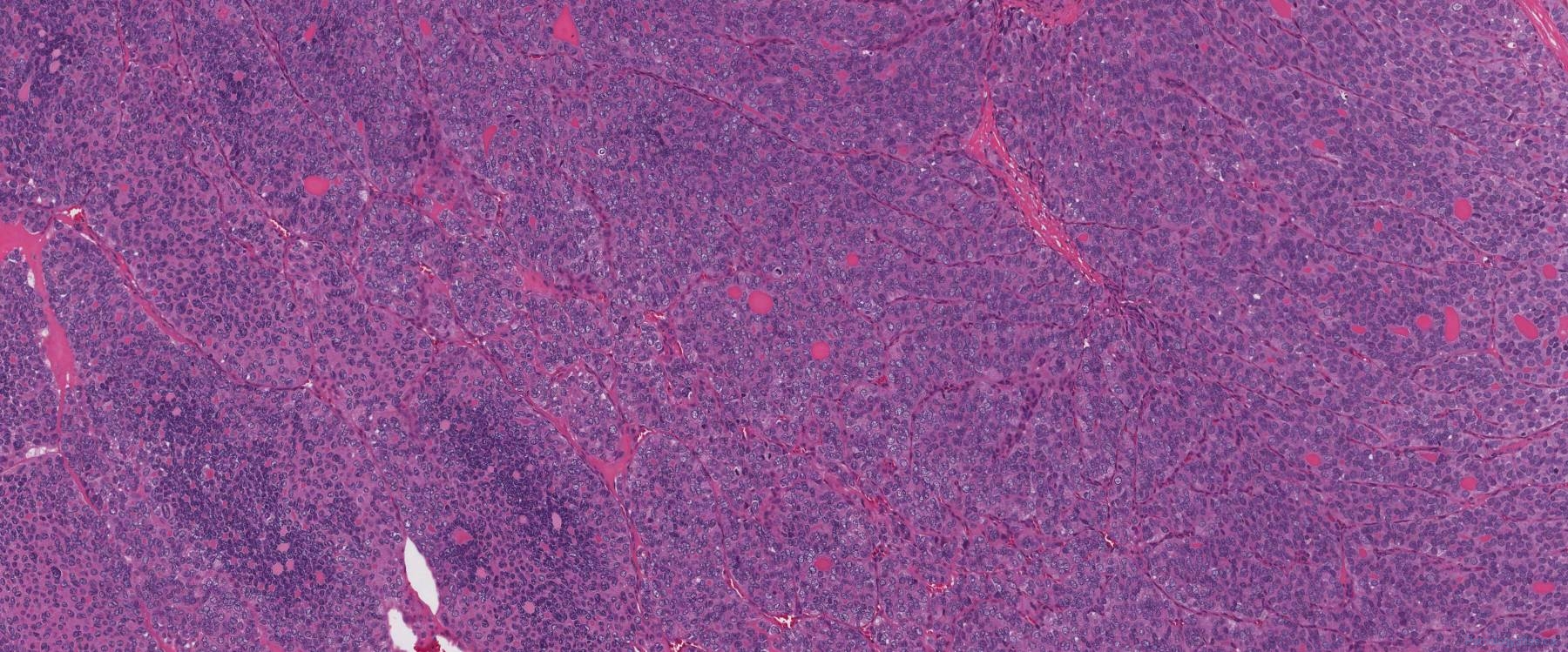 Poorly Differentiated Thyroid Carcinoma Atlas Of Pathology