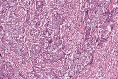 Poorly differentiated thyroid carcinoma