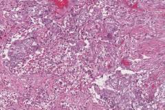 Poorly differentiated thyroid carcinoma