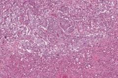 Poorly differentiated thyroid carcinoma