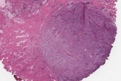 Post operative spindle cell nodule in the bladder