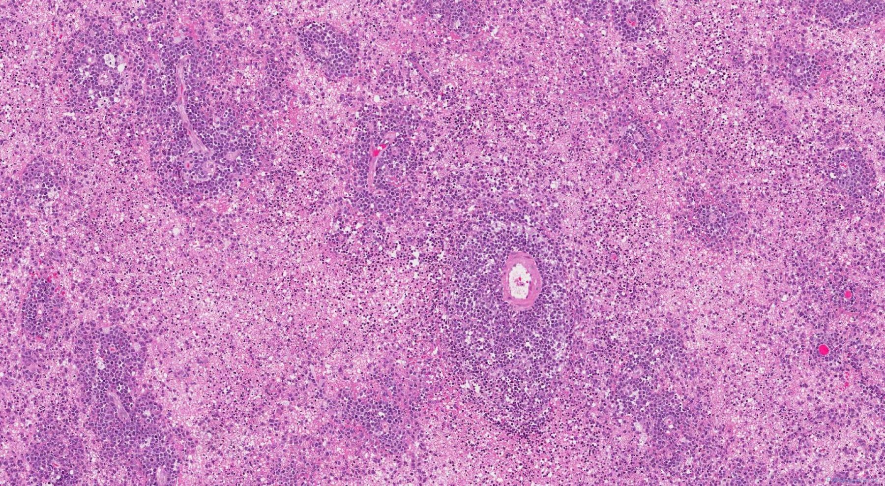 Primary CNS Diffuse Large B Cell Lymphoma | Ottawa Atlas Of Pathology