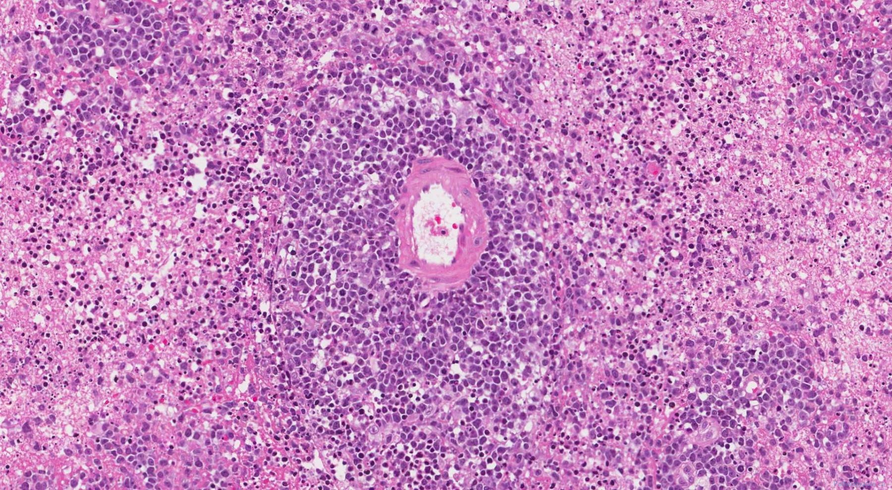 Primary CNS Diffuse Large B Cell Lymphoma | Ottawa Atlas Of Pathology