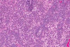 Primary CNS diffuse large B cell lymphoma