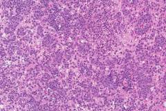 Primary CNS diffuse large B cell lymphoma