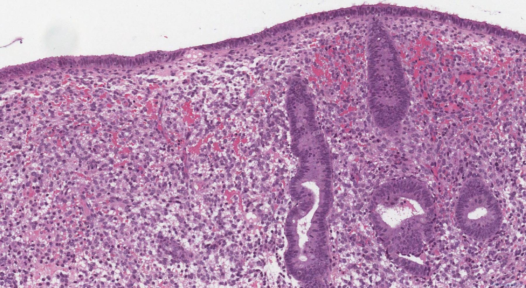 Proliferative Endometrium Mypathologyreport Ca Hot Sex Picture