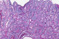 Pyloric gland adenoma of the stomach