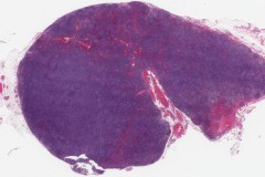 Reactive lymphadenopathy