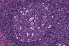 Reactive lymphadenopathy: Tingible body macrophages