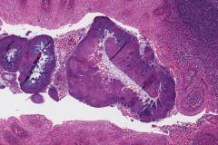 Reactive lymphoid hyperplasia of the palatine tonsil: Actinomyces