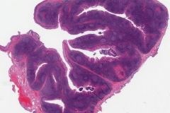Reactive lymphoid hyperplasia of the palatine tonsil