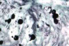 Blastomyces dermatitidis