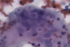 Blastomyces dermatitidis