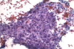 Granuloma