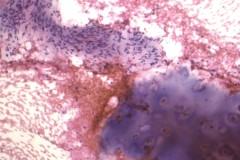 Hamartoma of the lung