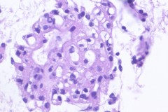 Metastatic renal cell carcinoma