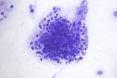 Metastatic renal cell carcinoma