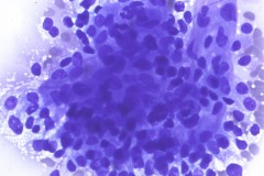 Metastatic renal cell carcinoma