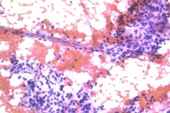 Metastatic renal cell carcinoma