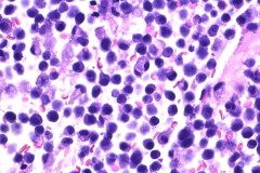 Plasma cell myeloma