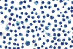 Plasma cell myeloma