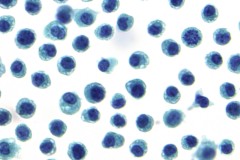 Plasma cell myeloma