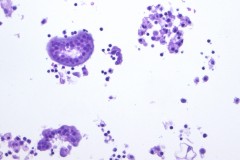 Metastatic adenocarcinoma