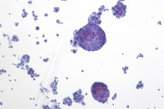 Metastatic adenocarcinoma