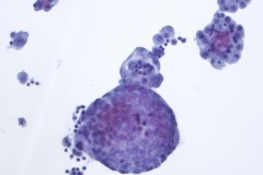 Metastatic adenocarcinoma