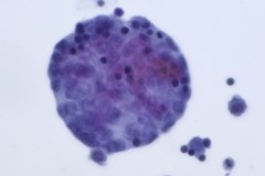 Metastatic adenocarcinoma