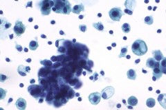 Small cell carcinoma